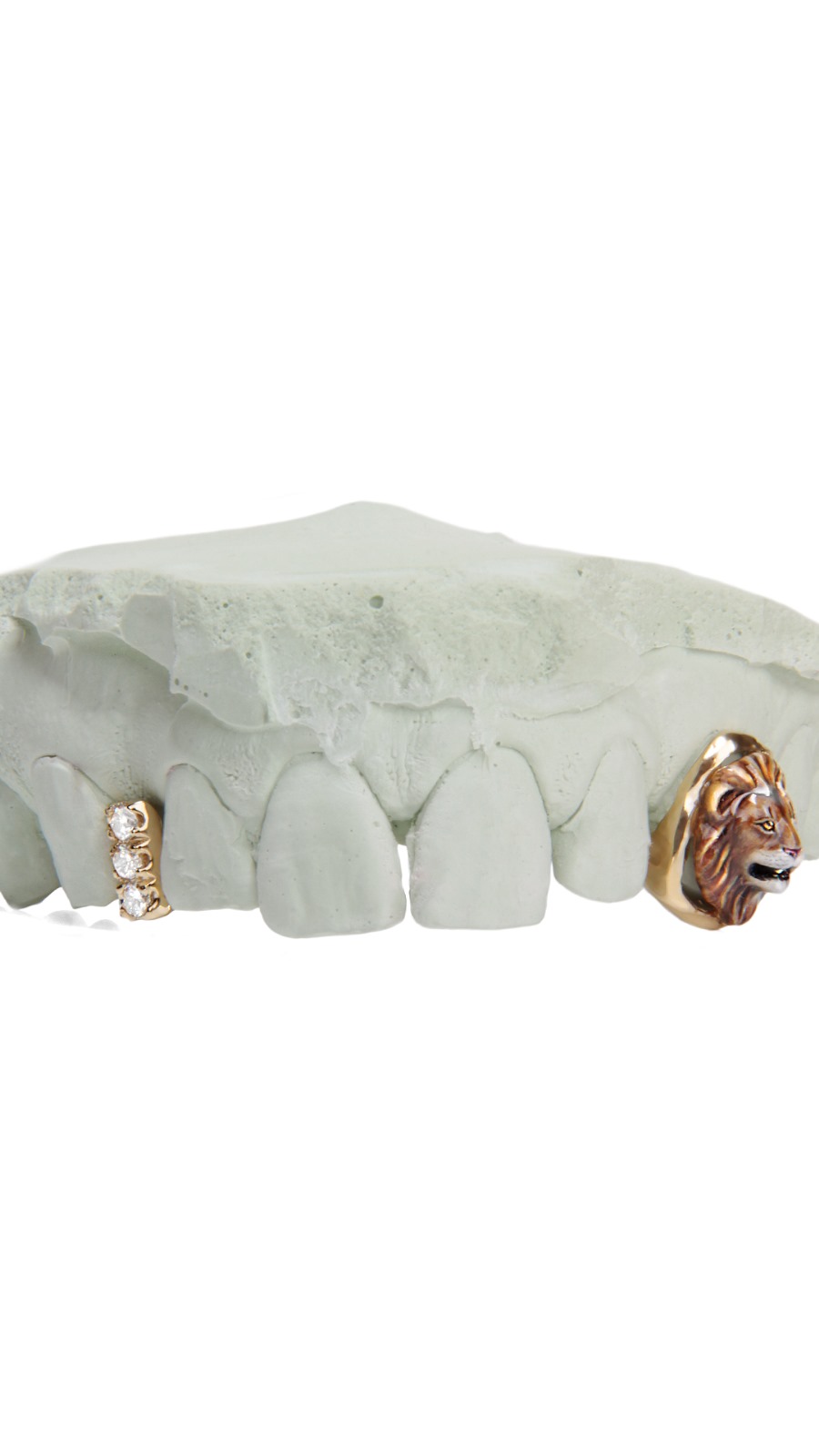 Custom Dental Gold